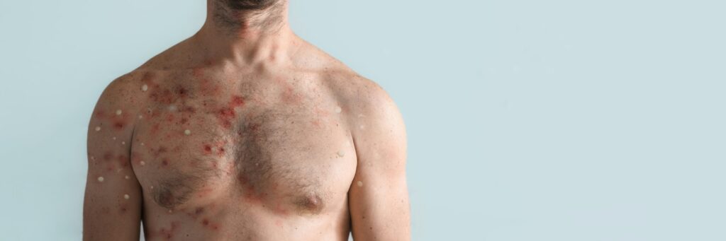 man with skin allergies