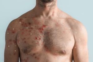 man with skin allergies